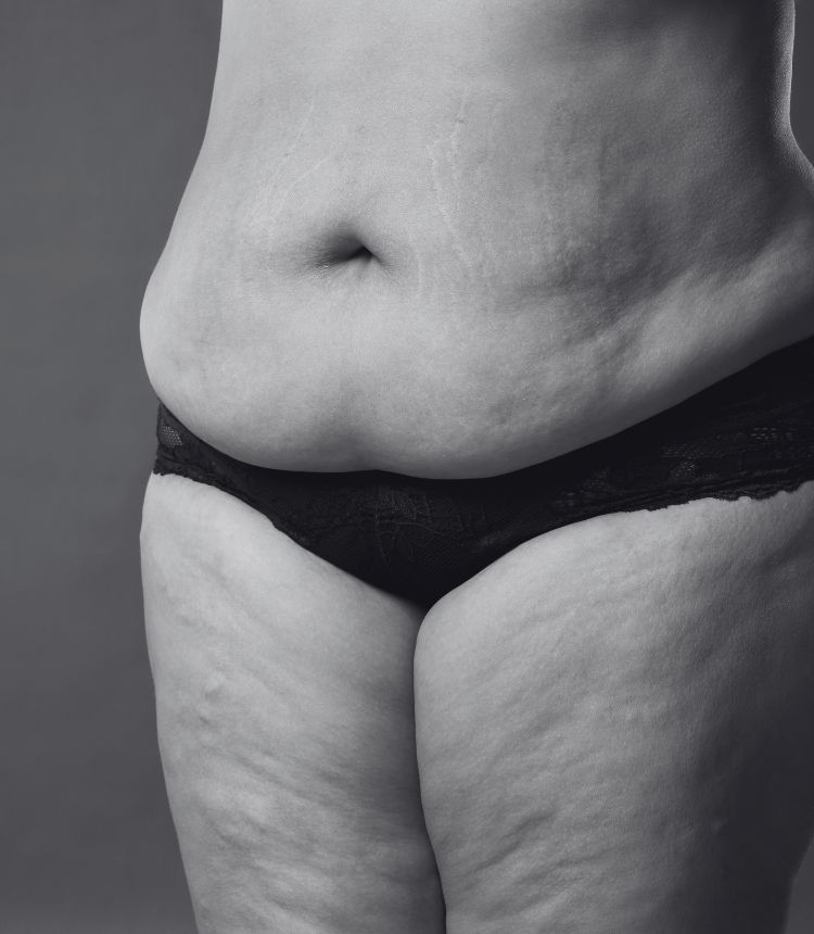 Image comparing mild and severe cellulite grades Bristol