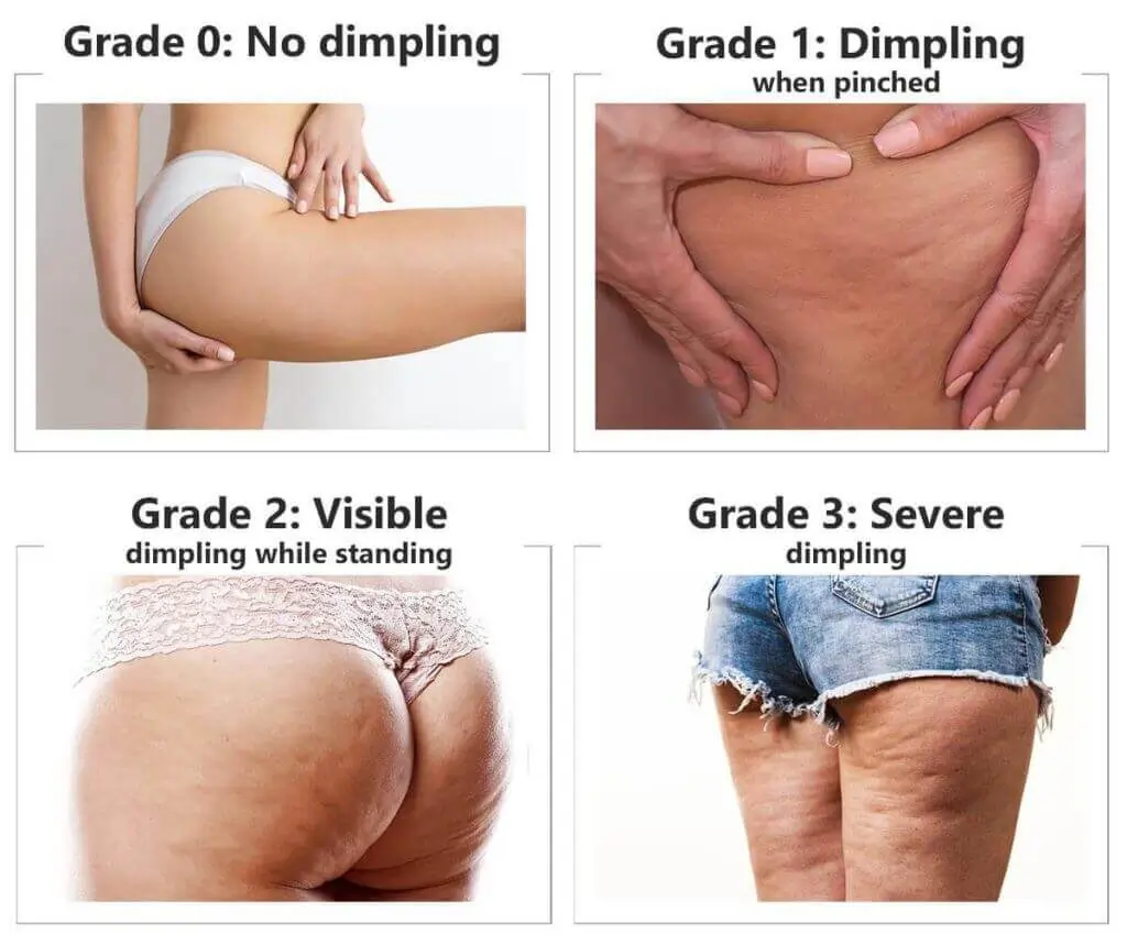 Representation of the stages of cellulite development Bristol